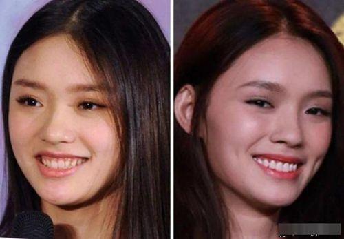 小明星网红戴牙套,美丽蜕变见证口腔健康之路